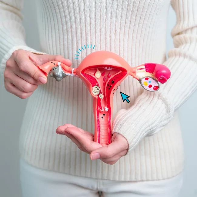 Миома матки: путеводитель по симптомам, лечению и профилактике