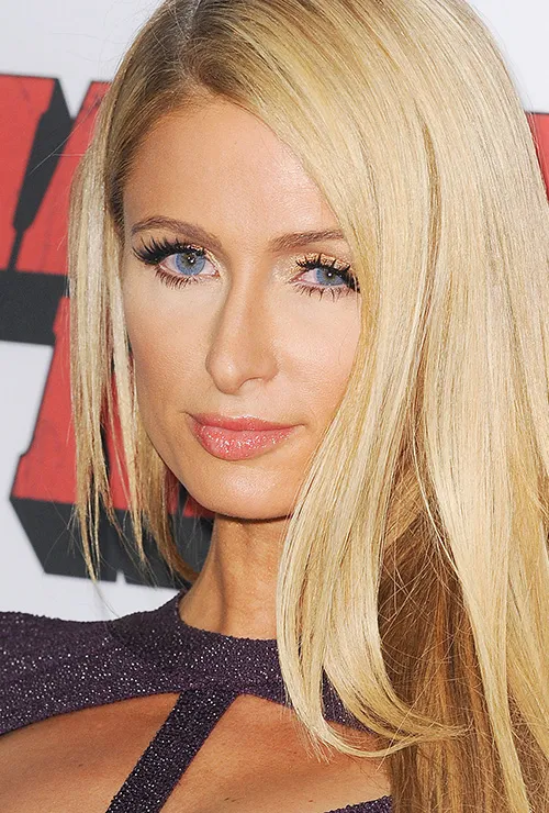 блефаропластика звезд фото до и после