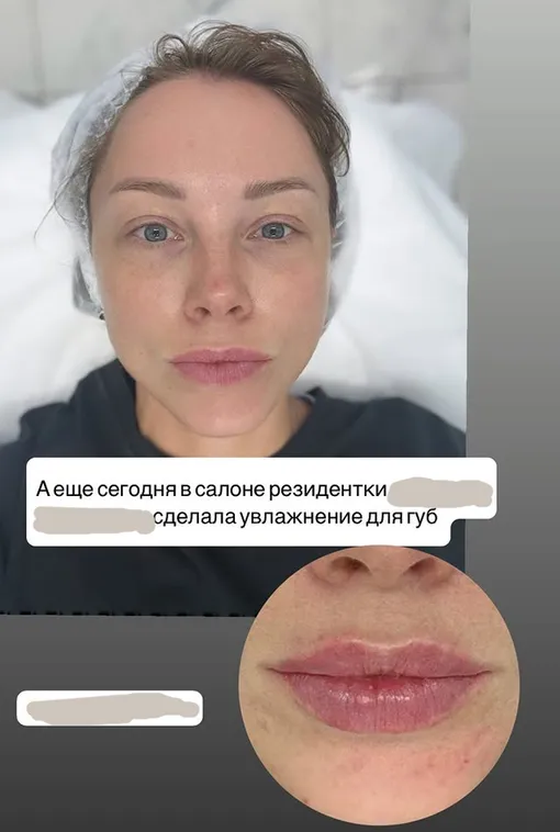 Полина Диброва подкорректировала губы