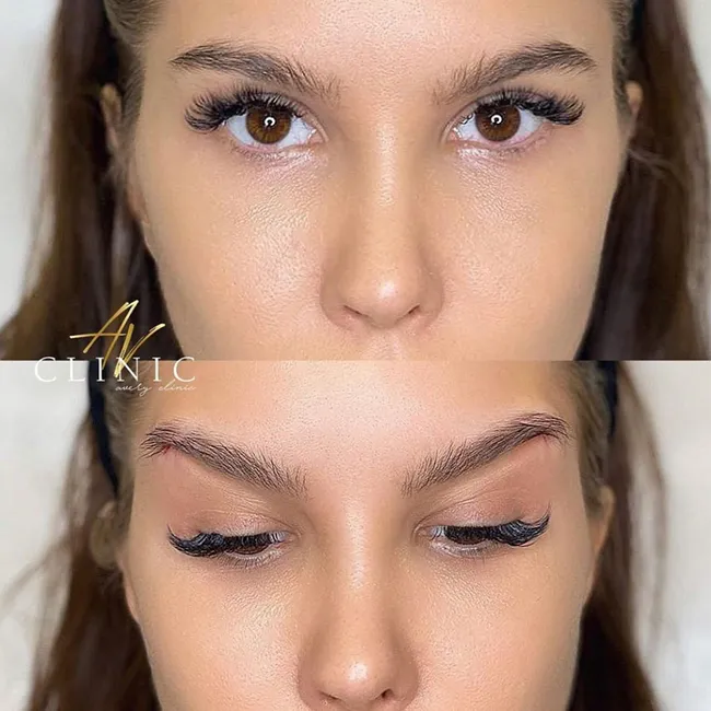 Притягивают за уши! Что такое кантопластика и почему на ней все помешались