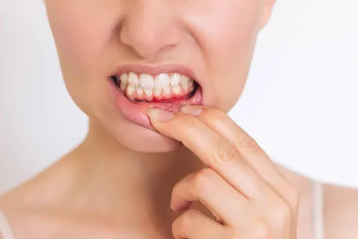 зубы после вейпа