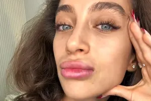 «Мне тяжело говорить»: жена Влада Соколовского показала губы после удаления филлеров