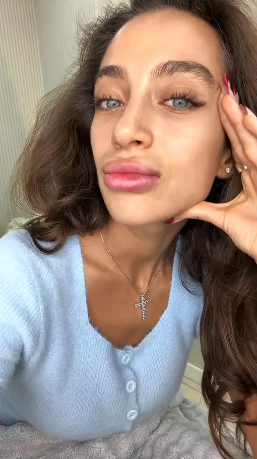 Ангелина Суркова убрала гель из губ, но результат увидит только через несколько дней