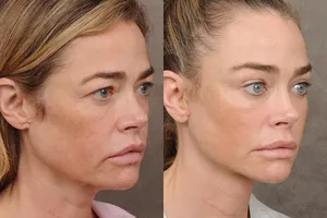 «Ее стойкость поражает»: пластический хирург Дениз Ричардс раскрыл подробности экстремальной подтяжки ее лица