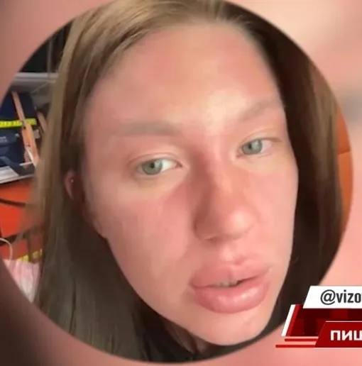 Дарья Зинова попала в больницу после похода к косметологу Дарья Зинова попала в больницу после похода к косметологу