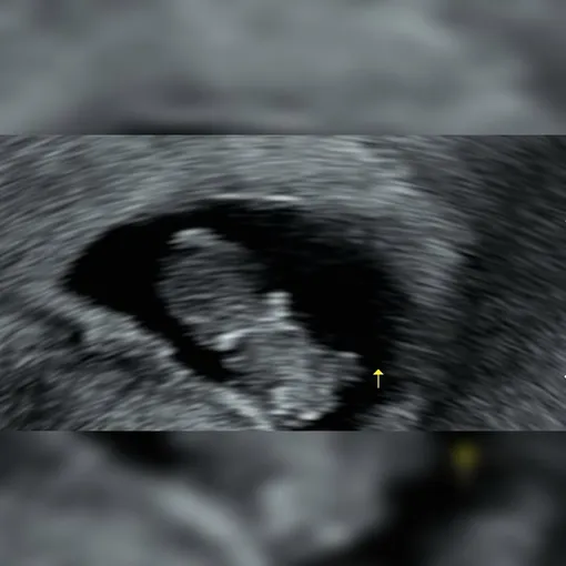 Юна из AOA также поделилась снимком УЗИ Юна из AOA также поделилась снимком УЗИ