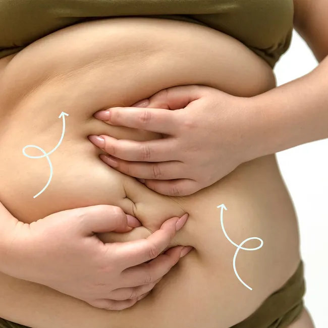 Липоскульптурирование живота — в чем его опасность? Рассказывает хирург