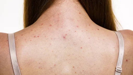 ванна с уксусом от прыщей ванна с уксусом от прыщей