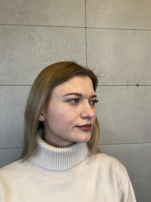 Окончательный результат: год после ринопластики