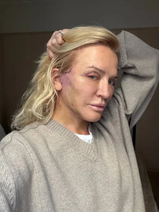 Виктория Шелягова два года решалась на пластическую операцию