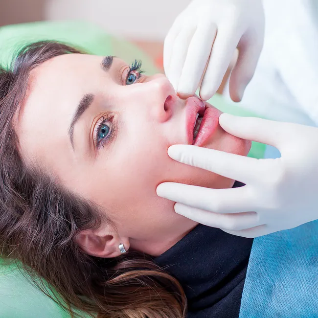 Что такое lip lift и почему его выбирают женщины с «усталыми» губами, а не те, кто хочет пухлости