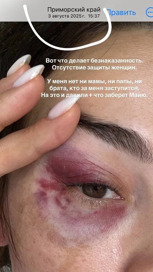 Ангелина показала синяки на лице после избиений мужа Ангелина показала синяки на лице после избиений мужа