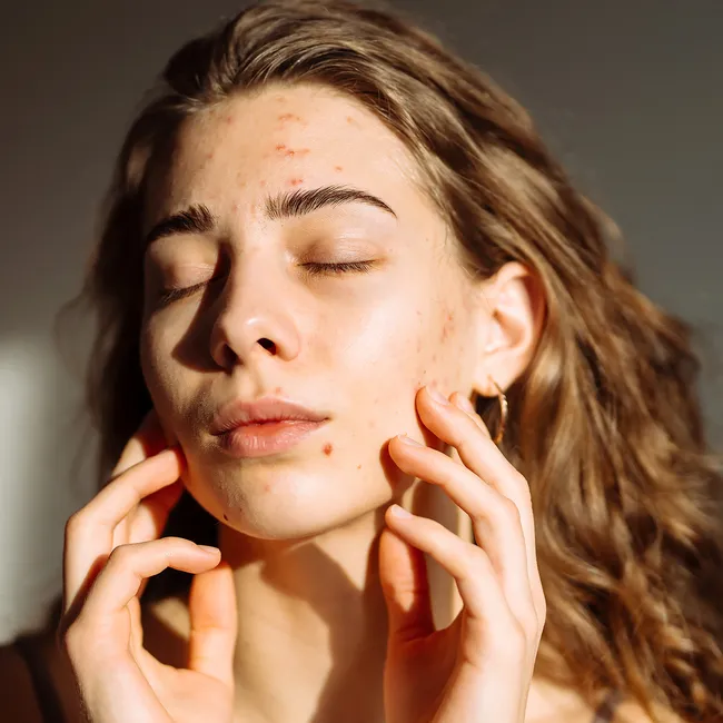 Что такое акне Майорка: эти таинственные высыпания на коже появляются только летом