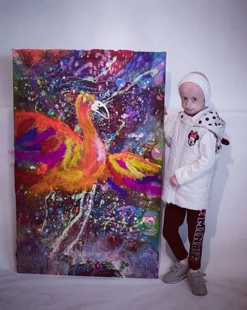 Девочка страдала от прогерии