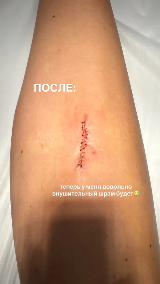 Мария Гладких показала шрам на ноге Мария Гладких показала шрам на ноге