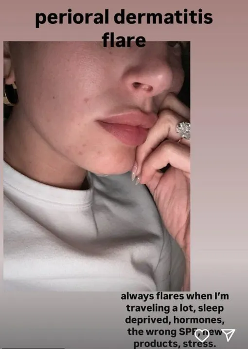 Хейли Бибер откровенно рассказала о проблемах с кожей Хейли Бибер откровенно рассказала о проблемах с кожей
