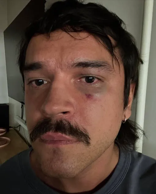 Никита Калмыков снял побои