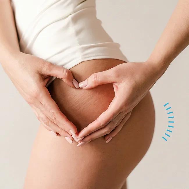 Пластический хирург назвал лучшие способы борьбы с растяжками