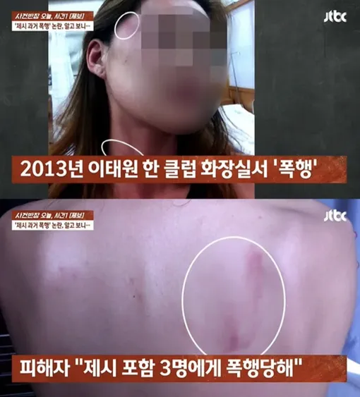 Канал JTBC показал фото побоев предполагаемой жертвы прошлого нападения Канал JTBC показал фото побоев предполагаемой жертвы прошлого нападения