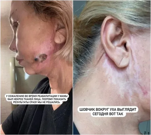 Виктория Боня показывала шокирующие последствия операции мамы Виктория Боня показывала шокирующие последствия операции мамы