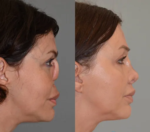 Алиса Казьмина вернула нос