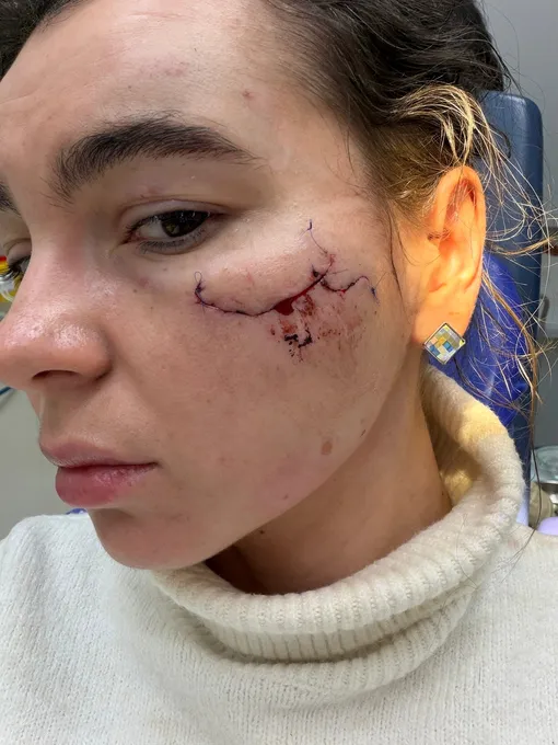 Надежда Шустова заявила, что изуродованное лицо останется у нее на всю жизнь Надежда Шустова заявила, что изуродованное лицо останется у нее на всю жизнь