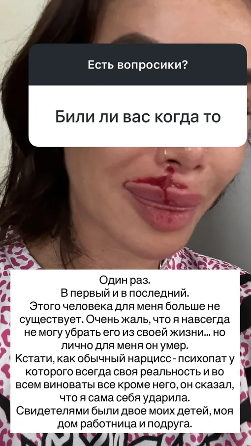 Айза показала лицо с разбитой губой Айза показала лицо с разбитой губой
