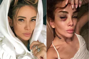 «Я дура года!»: у Айзы Анохиной произошел нервный срыв после пластики лица «Я дура года!»: у Айзы Анохиной произошел нервный срыв после пластики лица