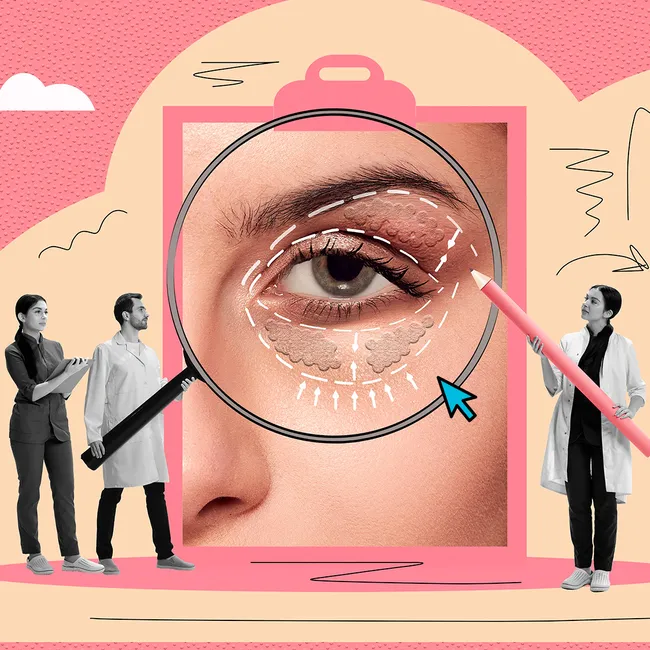 Что такое птоз век и почему это может быть опасно