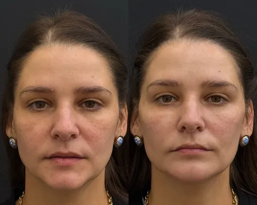 Глафире Тархановой сделали пластику лица Глафире Тархановой сделали пластику лица