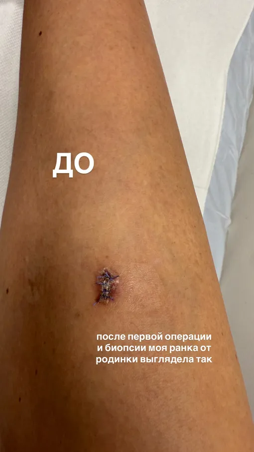 Мария Гладких показала ногу после первой операции Мария Гладких показала ногу после первой операции