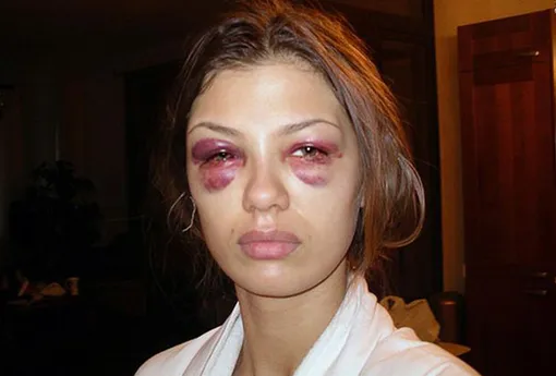 звезды после блефаропластики фото