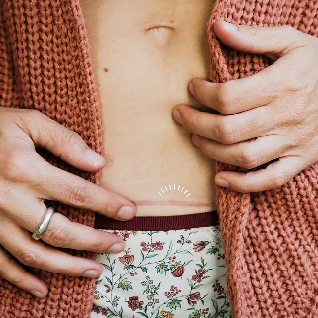 Шрамы после пластики: почему иногда их видно, а иногда нет — объясняет пластический хирург