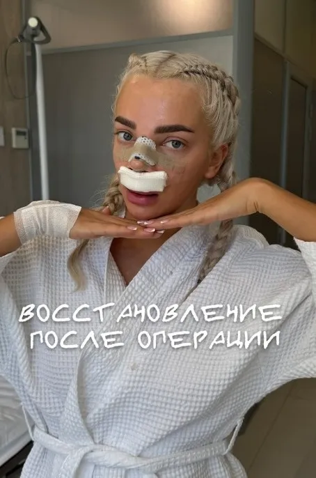 Екатерина Шкуро после ринопластики