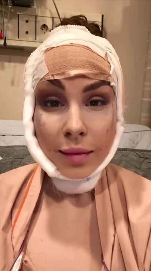 Анастасия Швецова после пластики