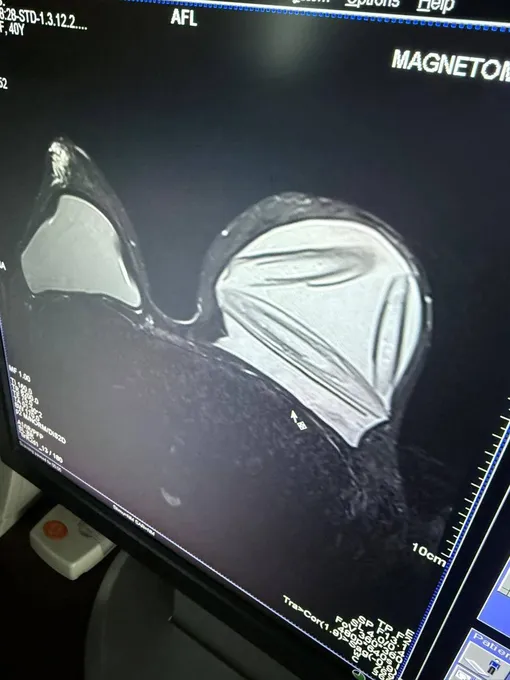 У Елены Товстик разорвался имплант У Елены Товстик разорвался имплант