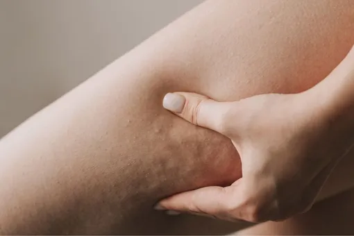 Целлюлит победить легче, чем кажется — вот что тебе поможет Целлюлит победить легче, чем кажется — вот что тебе поможет