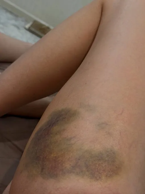 Клава Кока показала жуткие синяки Клава Кока показала жуткие синяки