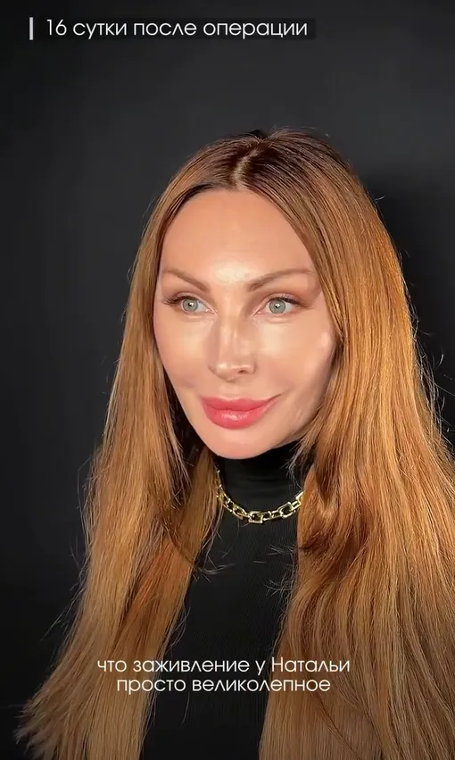 Наталья Бочкарева через 16 дней после пластики