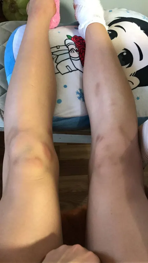 Алина Загитова показала ноги в синяках Алина Загитова показала ноги в синяках
