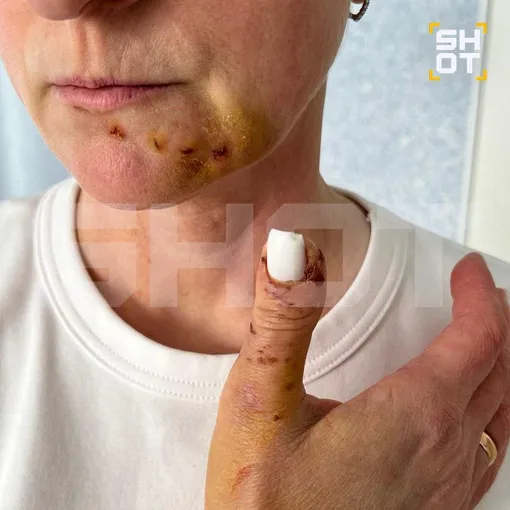 Ирину искусала собака Ирину искусала собака