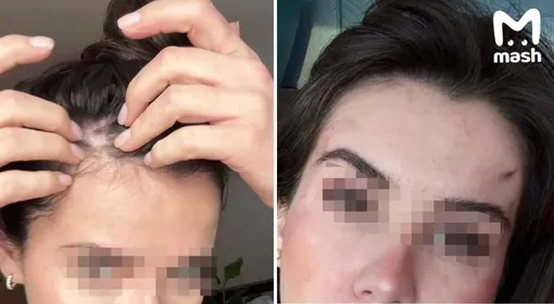 Эльвира заявила, что хирург ее изуродовал