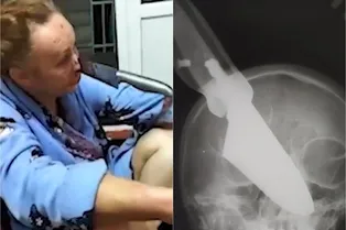 Россиянка выжила после того, как муж воткнул в ее лицо нож: жуткое видео Россиянка выжила после того, как муж воткнул в ее лицо нож: жуткое видео