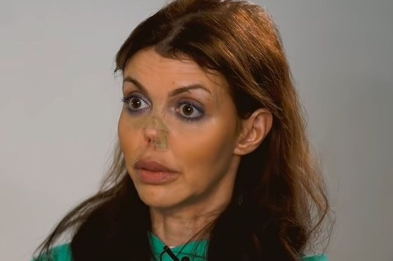 Аршавина с новым носом. Аршавина с новым носом. Аршавин и алиса казьмина. Жена аршавина алиса казьмина болезнь. Аршавина с новым носом.