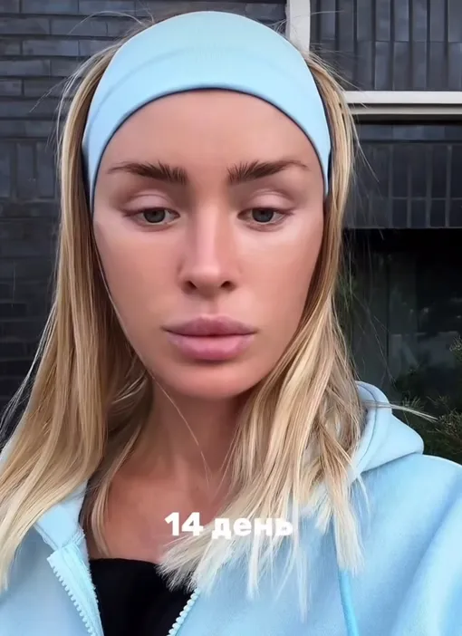 Кристина Лясковец на 14-й день после пластики Кристина Лясковец на 14-й день после пластики