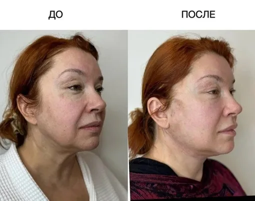Вера Сотникова до и после процедуры Вера Сотникова до и после процедуры