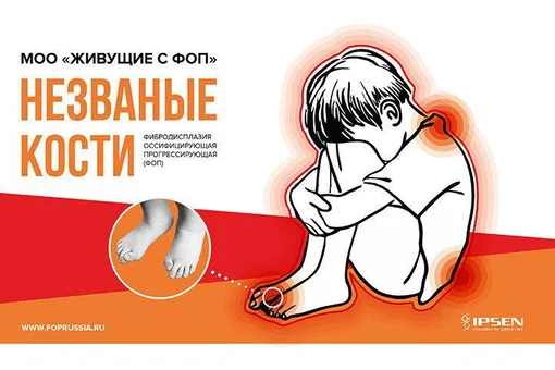 «Незваные кости»: как повысить качество жизни пациентов с ФОП «Незваные кости»: как повысить качество жизни пациентов с ФОП