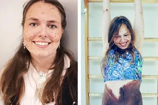 22-летняя художница из Норвегии гордится миллионом своих родинок 22-летняя художница из Норвегии гордится миллионом своих родинок