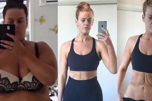 Бывшая толстушка показала обратную сторону экстремального снижения веса Бывшая толстушка показала обратную сторону экстремального снижения веса