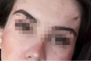 «Изуродовал мое лицо и потребовал обнажить грудь»: россиянка Эльвира потребовала от московского хирурга 1,7 млн рублей